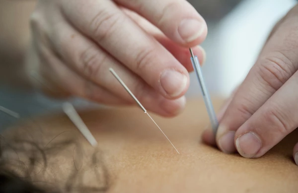 France Territoires, image Acupuncteurs